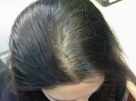 pérdida de cabello en mujeres