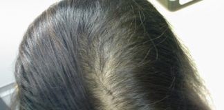 pérdida de cabello en mujeres