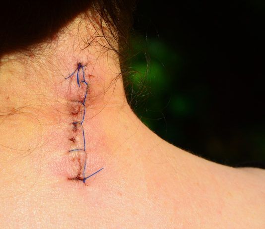 Las cicatrices y la esteticidad, ¿Cómo hacer desaparecer estas marcas?